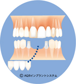 インプラント