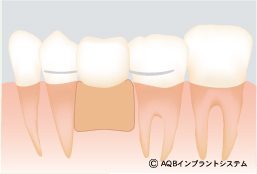 インプラント