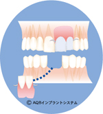 インプラント